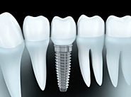 Get Complete Dental Implants Services