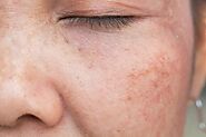 Skin Pigmentation Treatment in Delhi