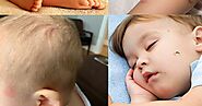 HOME REMEDIES FOR BUG BITE IN BABIES AGE 6 MONTHS TO 12 MONTHS