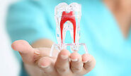 When Do You Require Root Canal Treatment? -RiteSmile Dental