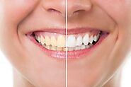 Benefits of Teeth Whitening. Everyone wants a juvenile smile…