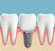 Benefits and Price of Dental Implants: Ritesmile...