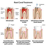 Root Canal Therapy – A Step By Step Guide