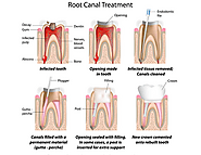 Root Canal Therapy Arana Hills | Teeth Whitening | Admire Dentistry