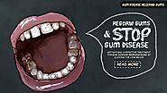 Gum Disease Receding Gums Treatment