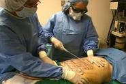 Low cost Liposuction surgery in Mexico