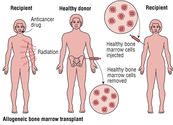 Bone Marrow Transplantation in India