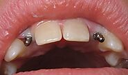 Quanto tempo duram os Implantes dentários ?
