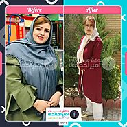 انواع جراحی لاغری و رسیدن به تناسب اندام - کلینیک فوق تخصصی لاغری