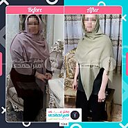 روش های کوچک کردن معده بصورت موقت و دائم - کلینیک فوق تخصصی لاغری