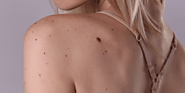 Skin Tags: Know The Causes And How To Remove It - Trend Bytes