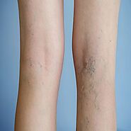 How you can Get Rid of Varicose Veins and Spider Veins