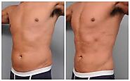 Website at https://www.storeboard.com/blogs/beauty-and-fashion/liposuction-in-dubai/3772322