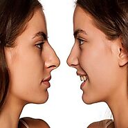 Rhinoplasty in Dubai, Abu Dhabi & Sharjah | Nose Reshaping Clinic Cost