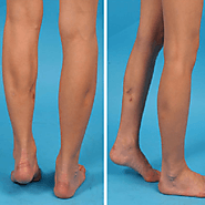 Calf Reduction Surgery in Dubai, Abu Dhabi & Sharjah | Calf Implants