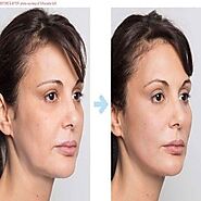 Thread Lift Treatment in Dubai, Abu Dhabi & Sharjah | Silhouette Cost