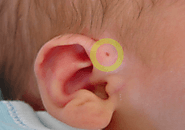 Trẻ có lỗ nhỏ ở vành tai có nguy hiểm không? Điều trị ở đâu?