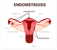 What is the Best Treatment for Endometriosis in UK?