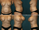 Breast Augmentation Tampa - Breast Implants Tampa, FL