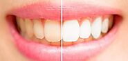 Are your yellow teeth causing a lasting impact on you? - kiambeauty