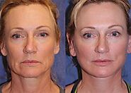 Best Facial Cosmetic and Blepharoplasty Surgery in Chicago