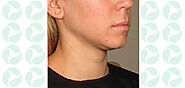 Ultherapy. Use the power of ultrasound to lift and tighten your neck, chin, and brow. Now serving Tarzana, Calabasas,...