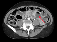 https://www.literaturepublishers.org/archive/Recurrent-Phytobezoar-Presenting-with-Small-Bowel-Obstruction.html