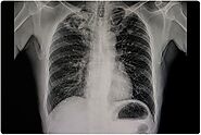 Stem Cell Therapy for Lung Fibrosis - Stemcellindia