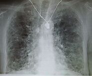 Stem Cell Therapy in Lung Fibrosis - Stemcellindia