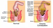 Why Fiber Causes Constipation and Hemorrhoids?