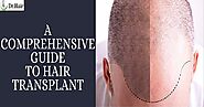 A Comprehensive Guide to Hair Transplant