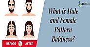 What Is Male and Female Pattern Baldness?