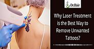 Why Laser Treatment Is the Best Way to Remove Unwanted Tattoos?