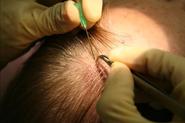 Cost for Hair Transplant Treatment in India | Hair Transplant Surgeons