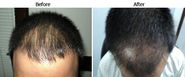 Hair Loss And Its Treatment in India