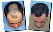 How To Choose Best Hair Transplant In India