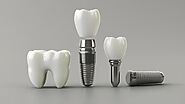 What Are the Risks Associated with Dental Implants?