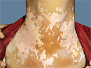 Look For These 5 Common Signs Of Vitiligo | Dr Paul's Clinic