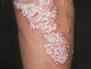Best Psoriasis Treatment in Delhi | Book An Appointment