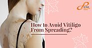 How to Avoid Vitiligo from Spreading | Skin Laser Centre