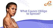 What Causes Vitiligo to Spread | Skin Laser Centre