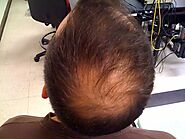 Hair Loss Treatment & Diagnosis | Book An Appointment Now | SLC