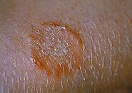 Prevention, Tips, and Home Remedies for Ringworm
