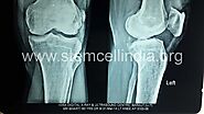 Stem Cell Therapy in Arthritis knee