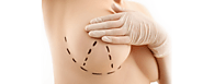 Breast lift Surgeon South Delhi | Breast Lift Surgery | Plastic Surgery