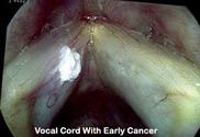 Voice and Swallowing Disorders surgery | Calwest Surgical Institute