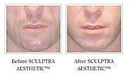 How sculptra treatment perfect for all aged skin ?