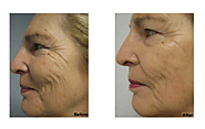 Skin Tightening By Calwestent's Doctor
