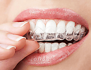 Teeth Whitening | Admire Dentistry