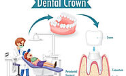 What You Need to Know About Root Canals and Dental Crowns